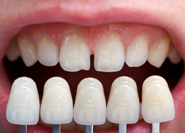 Что такое виниры на зубы