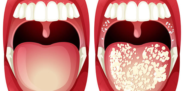 Лечим грибок в горле и его последствия – ЛОР-центр