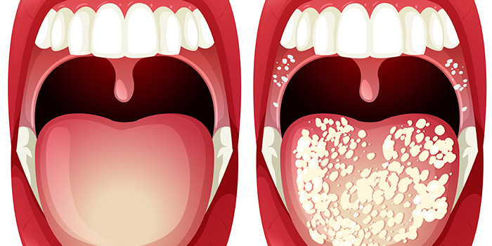 Кандидоз полости рта фотографии